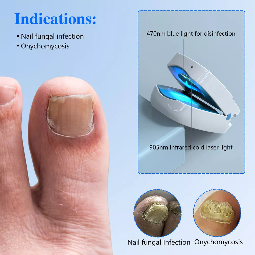 NailCare Laserbehandling mod Neglesvamp – Dobbeltbølget Terapi