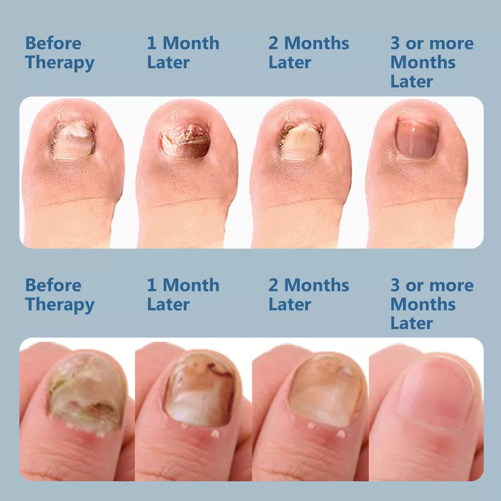 NailCare Laserbehandling mod Neglesvamp – Dobbeltbølget Terapi