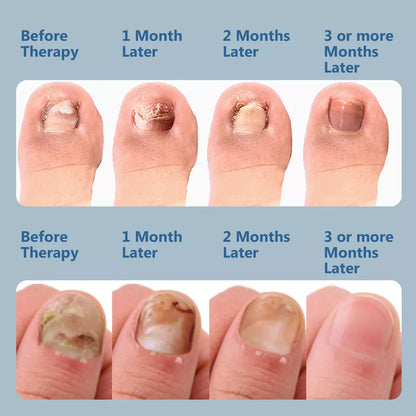 NailCare Laserbehandling mod Neglesvamp – Dobbeltbølget Terapi
