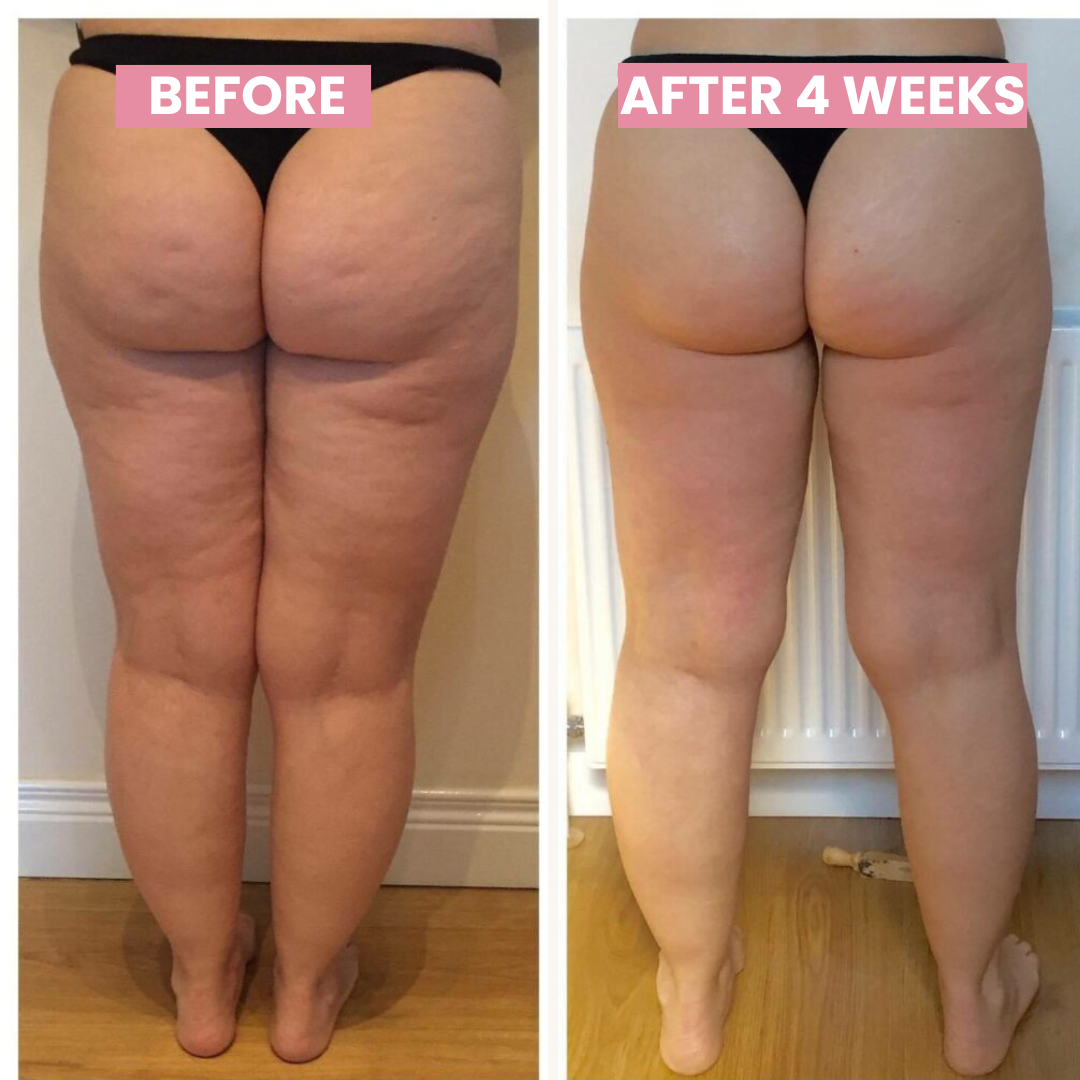 SlimCupp Anti-Cellulite Koppenhed med Infrarød Lysterapi